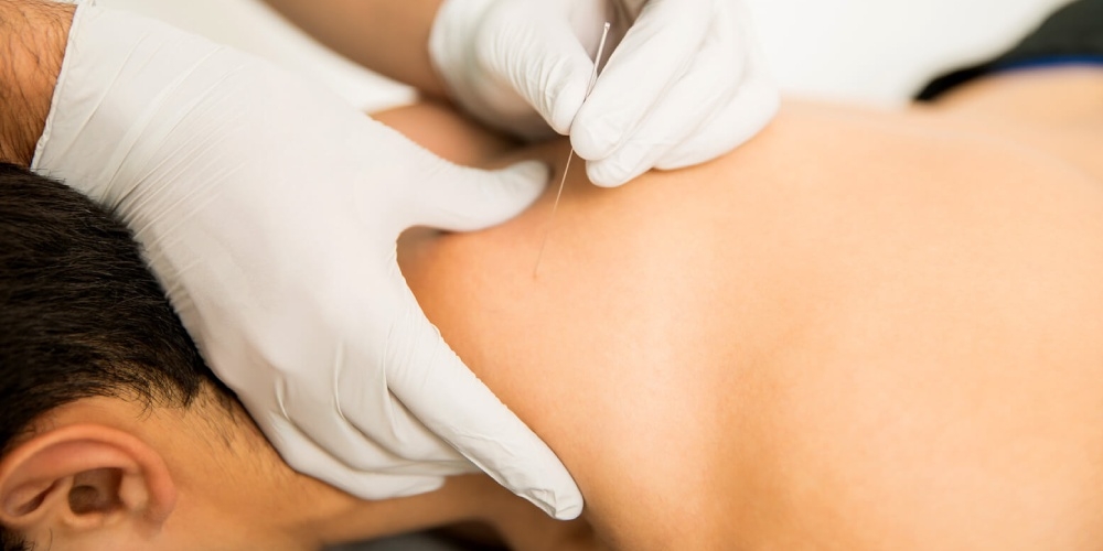 6 Reasons Why Dry Needling Therapy is Beneficial